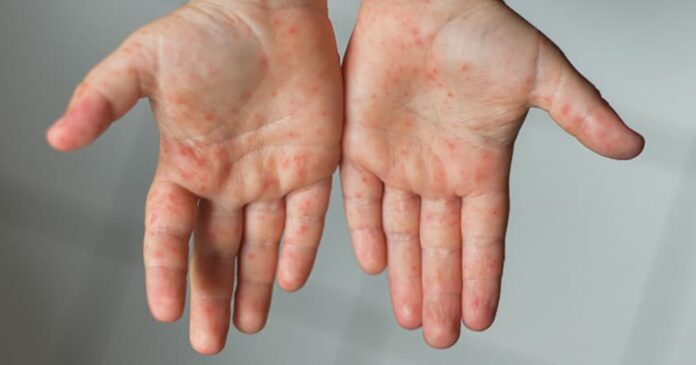 early signs hand foot and mouth day by day
